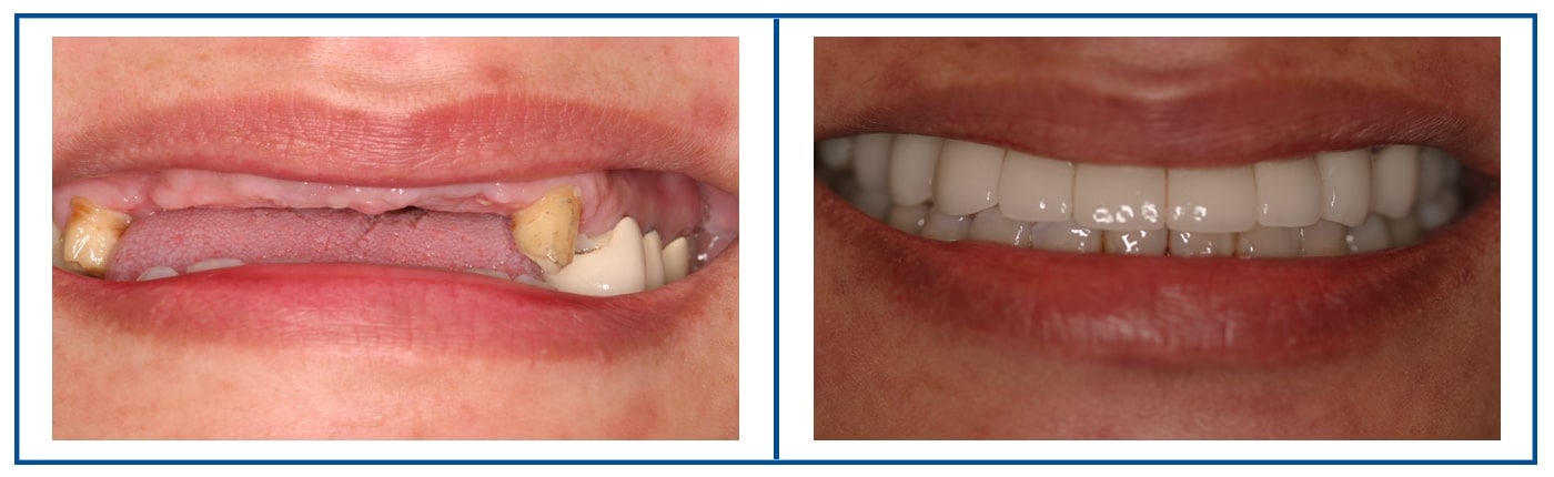 garngalao rosario implants