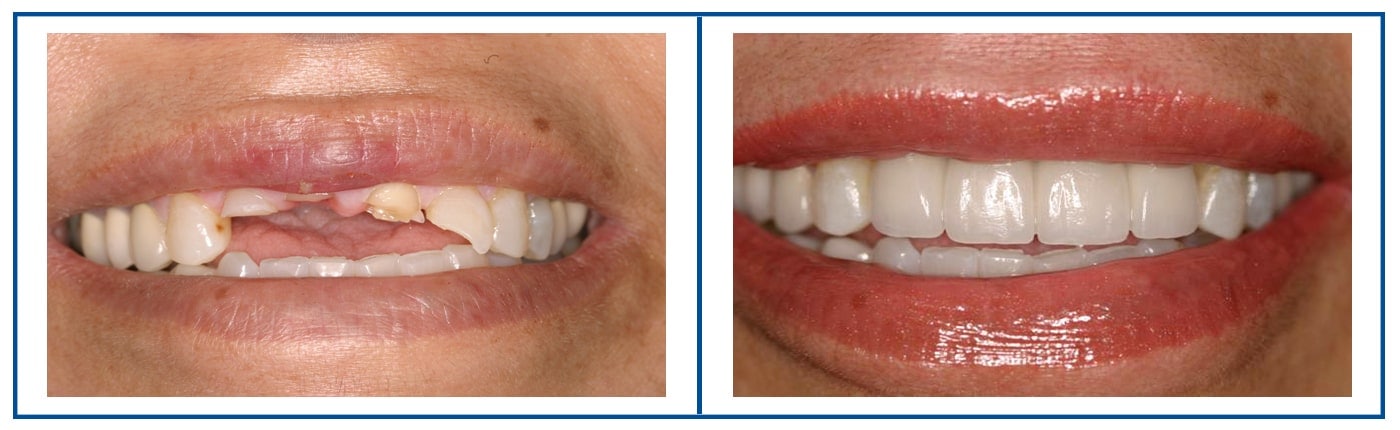 implantsandveneers 1